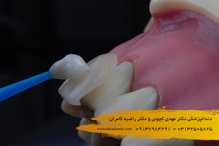 کامپوزیت-دندان-چیست-؟-دندانپزشکی-دکتر-مهدی-کچوئی-و-کامران