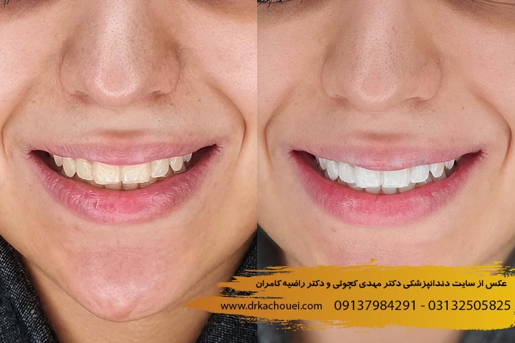 عکس قبل و بعد بلیچینگ دندان در اصفهان دکتر مهدی کچوئی
