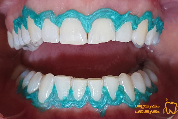 سفید کردن دندان اصفهان