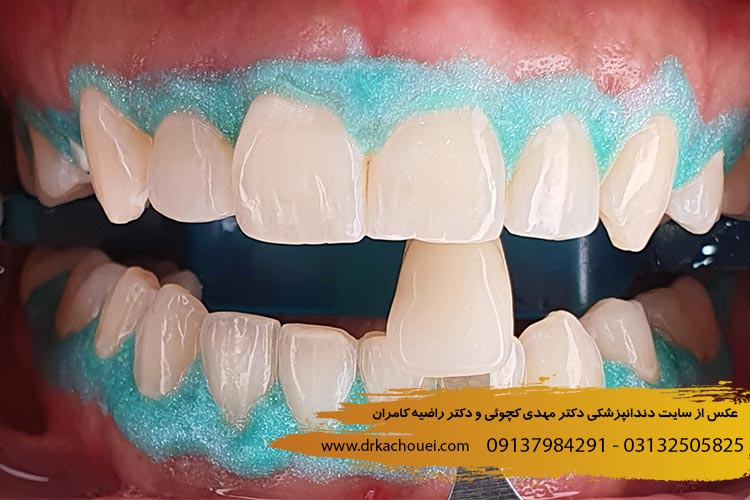 مراقبت های بعد از بلیچینگ دندان | دکتر مهدی کچوئی و دکتر راضیه کامران