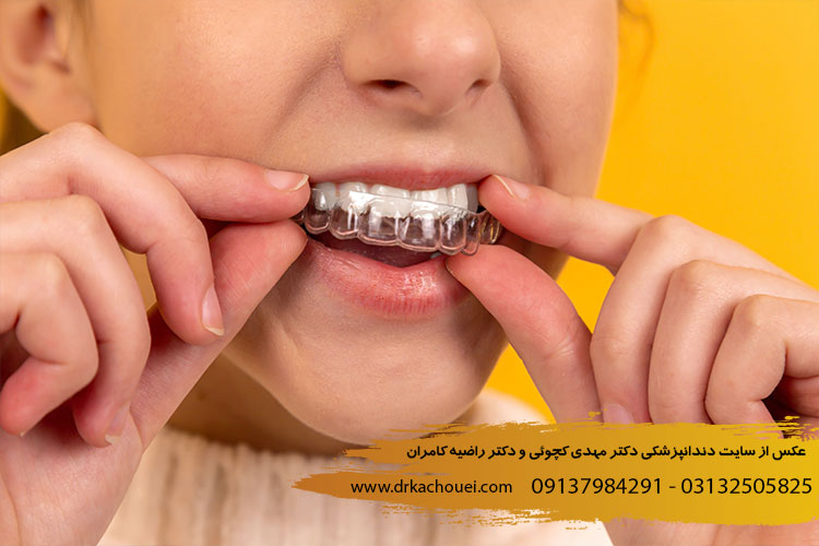 بلیچینگ یا سفید کردن دندان در خانه یا هوم بلیچینگ | دندانپزشکی مهدی کچوئی و راضیه کامران