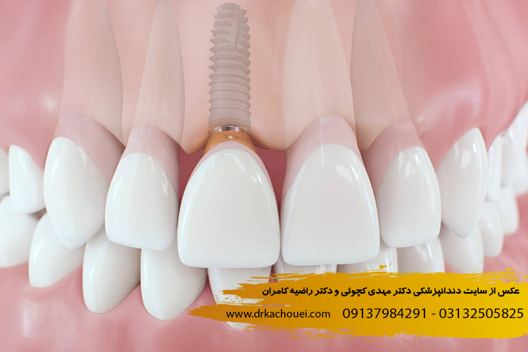 ایمپلنت دندان چیست؟ | مطب دکتر کچوئی و دکتر کامران