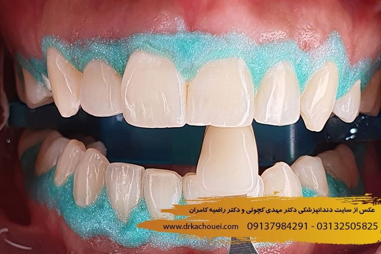 دوام بلیچینگ دندان | دندانپزشکی دکتر مهدی کچوئی و دندانپزشکی راضیه کامران