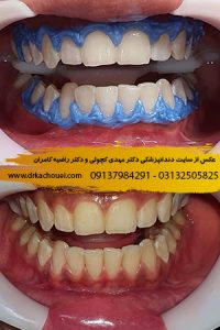 عکس قبل و بعد بلیچینگ دندان | دندانپزشکی دکتر کچویی و دکتر کامران