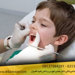 روکش دندان شیری کودکان+ انواع روکش دندان شیری