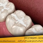 شیار پوش دندان (فیشور سیلانت) چیست؟ کاربرد + معایب و مزایا
