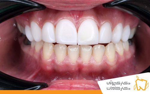 عکس بعد از کامپوزیت دندان در اصفهان | دندانپزشکی دکتر کچوئی و دکتر کامران