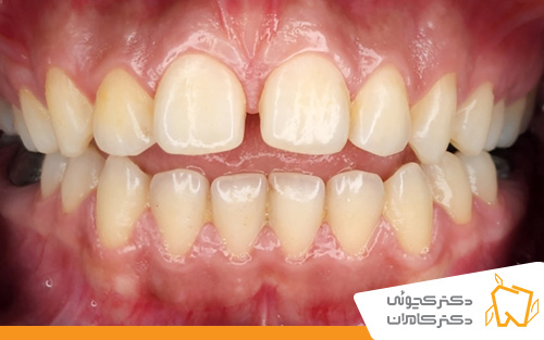 عکس قبل از کامپوزیت دندان در اصفهان | دندانپزشکی دکتر کچوئی و دکتر کامران