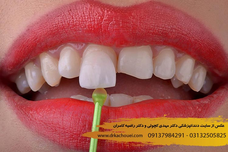 لمینت دندان چیست؟ دندانپزشکی دکتر مهدی کچوئی و راضیه کامران 