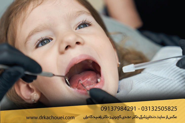 عصب کشی دندان شیری کودکان چگونه است؟ | دندانپزشکی دکتر مهدی کچویی و دکتر راضیه کامران