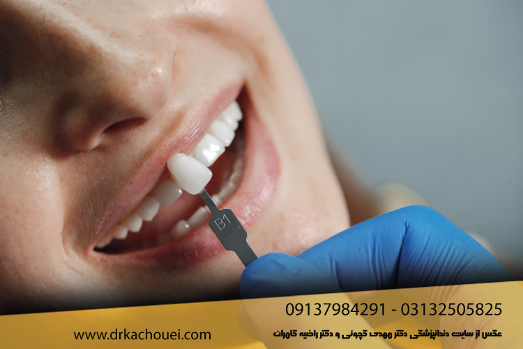 لمینت سرامیکی دندان چیست؟ | بهترین کلینیک دندانپزشکی ترمیم زیبایی دندان در اصفهان (دکتر کچویی و دکتر کامران)