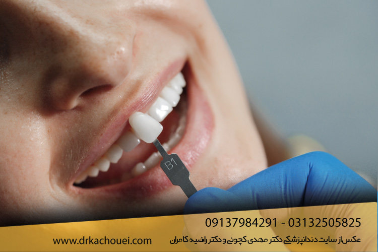 لمینت سرامیکی دندان بدون تراش چیست؟ | دندانپزشکی دکتر کچویی و دکتز کامران