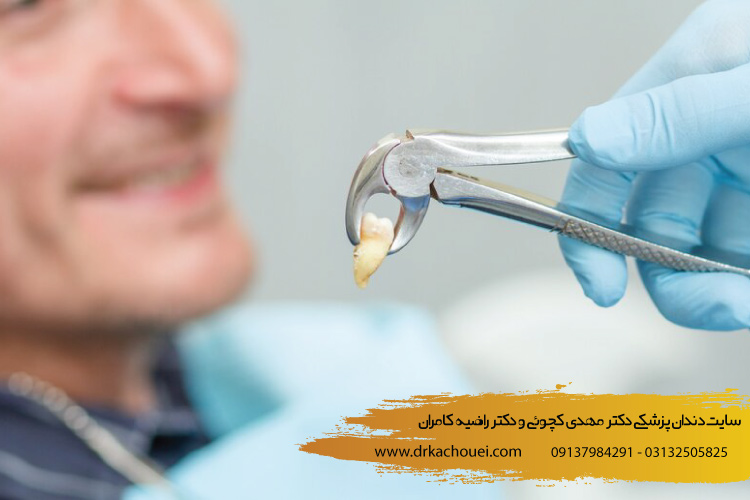 مراقبت های بعد از کشیدن دندان عقل | بهترین کلینیک دندانپزشکی ترمیم زیبایی دندان در اصفهان (دکتر کچویی و دکتر کامران)
