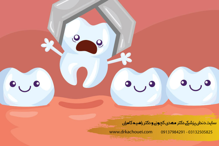 توصیه های بعد از کشیدن دندان | بهترین کلینیک دندانپزشکی ترمیم زیبایی دندان در اصفهان (دکتر کچویی و دکتر کامران)