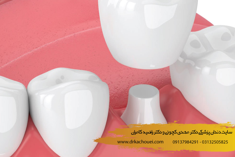 توصیه های بعد از روکش کردن دندان | بهترین کلینیک دندانپزشکی ترمیم زیبایی دندان در اصفهان (دکتر کچویی و دکتر کامران)