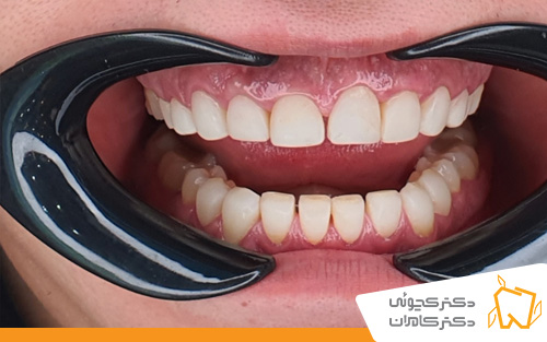 عکس-قبل-از-کامپوزیت-ونیر-در-اصفهان | بهترین دندانپزشکی اصفهان
