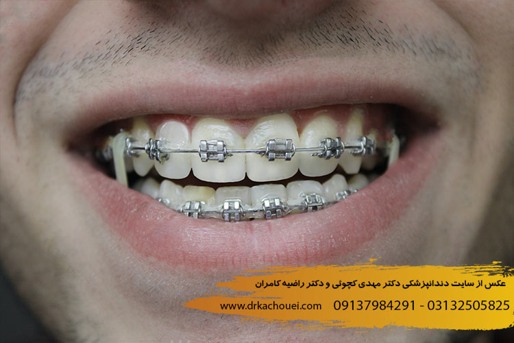 مراقبت های دوره انجام ارتودنسی دندان | دندانپزشکی دکتر مهدی کچوئی و راضیه کامران