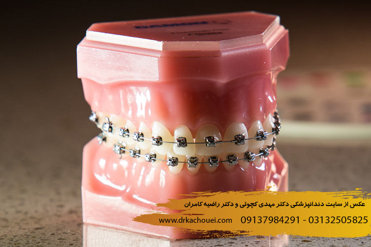مراقبت های بعد از ارتودنسی دندان نکات طلایی | دندانپزشک دکتر مهدی کچوئی و راضیه کامران