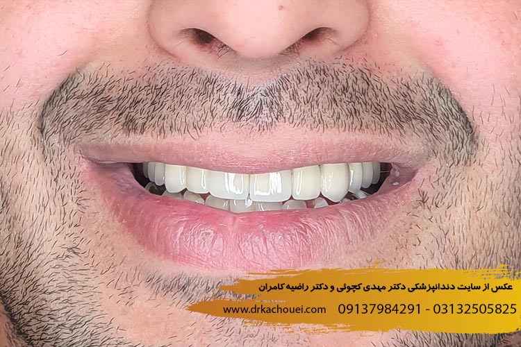 روکش دندان در اصفهان | دندانپزشکی زیبایی اصفهان دکتر مهدی کچوئی و دکتر راضیه کامران