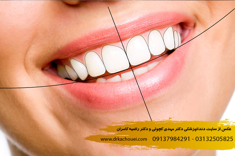 طرح لبخند در بهترین دندانپزشکی اصفهان | دکتر مهدی کچوئی و دکتر راضیه کامران