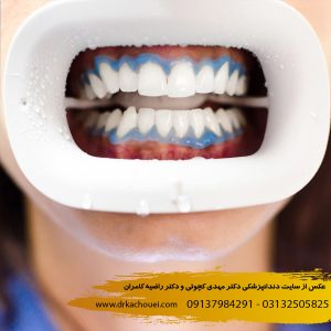 بلیچینگ دندان | دندانپزشکی دکتر مهدی کچوئی و دکتر راضیه کامران