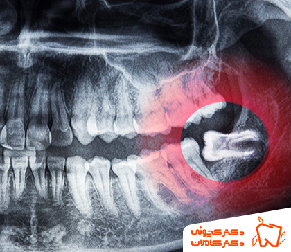 عکس دندان عقل نفته | دکتر مهدی کچوئی و دکتر راضیه کامران