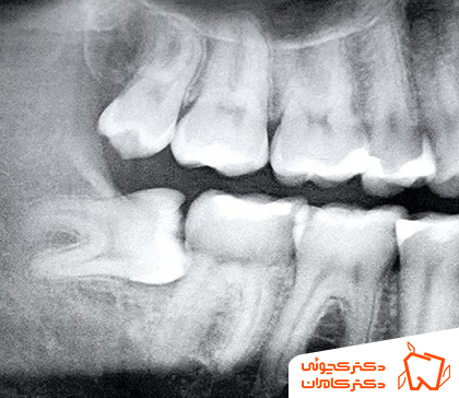 عکس دندان عقل نفته | دکتر مهدی کچوئی و دکتر راضیه کامران