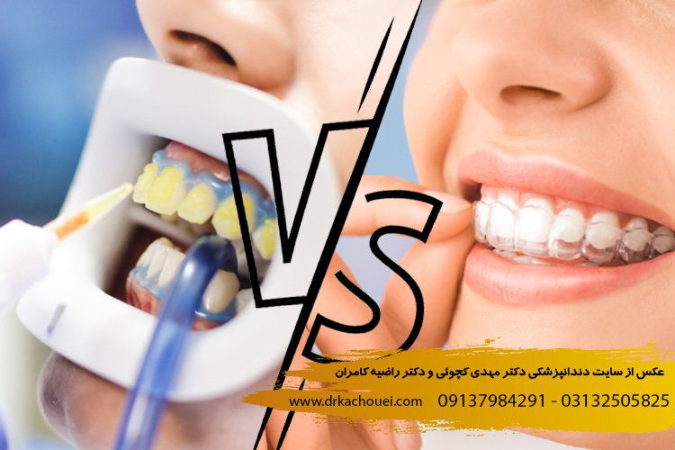 تفاوت هوم بلیچینگ و آفیس بلیچینگ | دندانپزشکی دکتر کچویی و دکتر کامران