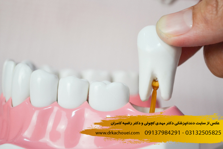 دندان عقل | دندانپزشکی دکتر مهدی کچوئی و دکتر راضیه کامران