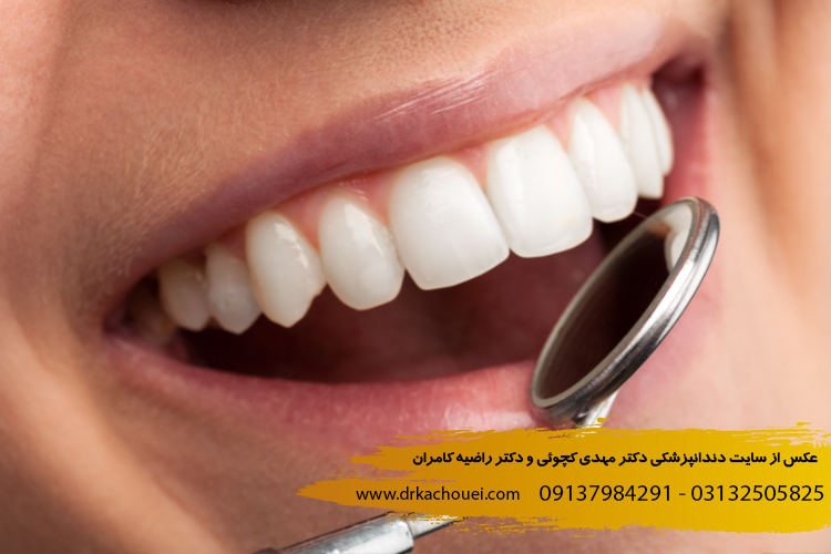 عوارض بلیچینگ دندان چیست؟ | دندانپزشکی دکتر کچوئی و دکتر کامران