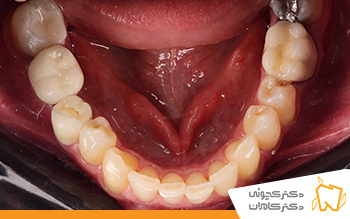 بعد از ایمپلنت دندان اصفهان | مطب دکتر کچوئی و دکتر کامران