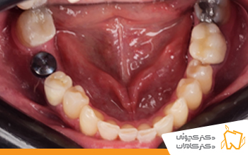 قبل از ایمپلنت دندان اصفهان | مطب دکتر کچوئی و دکتر کامران