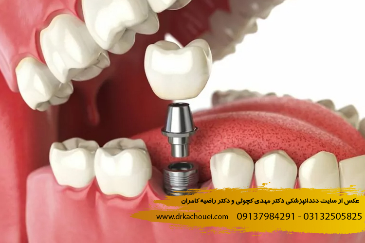 مزایا و معایب ایمپلنت دندان | دندانپزشکی دکتر کچوئی و دکتر کامران