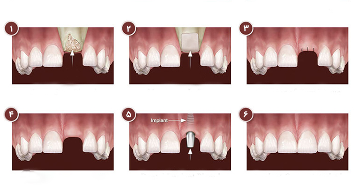 مراحل پیوند استخوان | دندانپزشکی دکتر کچوئی و دکتر کامران