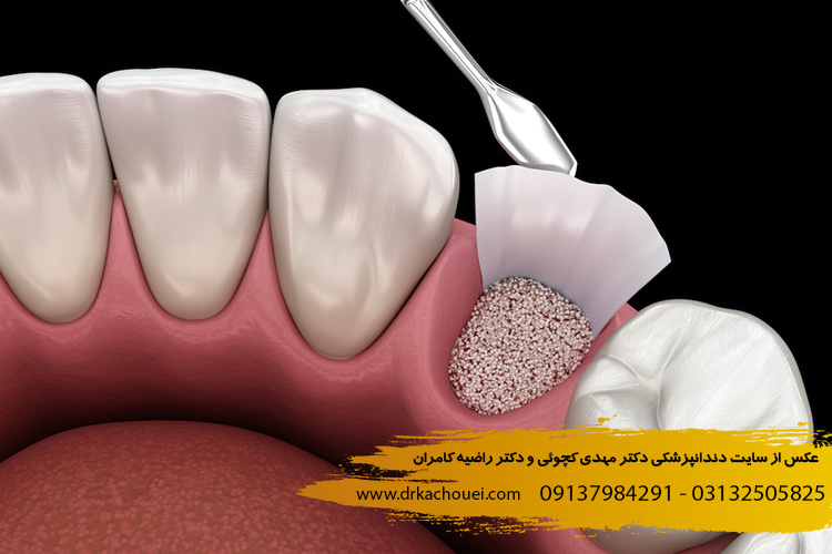 پیوند استخوان برای ایمپلنت | دندانپزشکی دکتر کچوئی و دکتر کامران