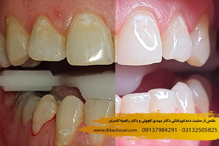 بلیچینگ دندان در اصفهان 