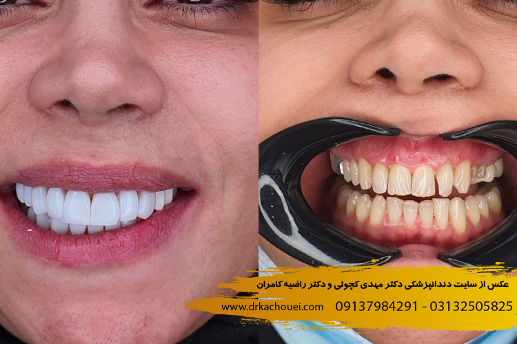 کامپوزیت دندان در بهترین دندانپزشکی اصفهان