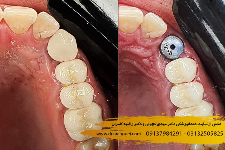 ایمپلنت دندان اصفهان
