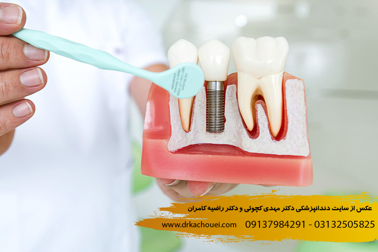 بررسی دلایل لق شدن ایمپلنت دندان