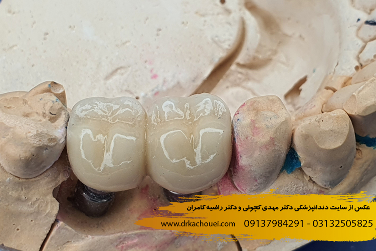 روکش ایمپلنت دندان چیست؟ | مراحل ساخت روکش