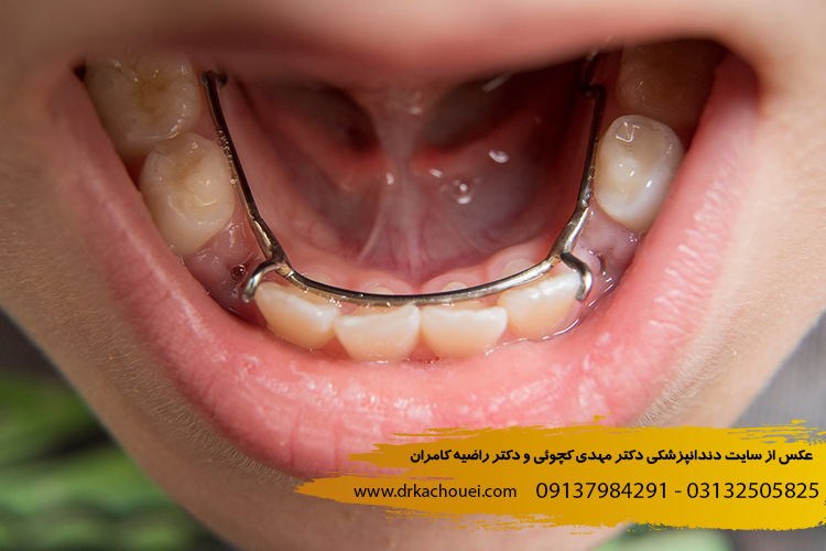 فضا نگهدارنده دندان کودک | دندانپزشکی دکتر مهدی کچوئی و دکتر راضیه کامران