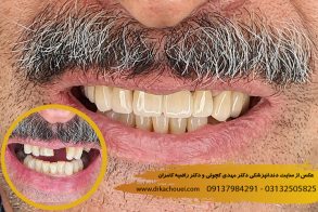 ایمپلنت دندان اصفهان | دندانپزشکی دکتر کچوئی و دکتر کامران