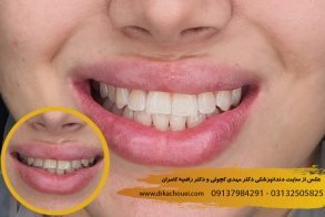 بلیچینگ دندان اصفهان |دندانپزشکی زیبایی اصفهان دکتر مهدی کچوئی و دکتر راضیه کامران
