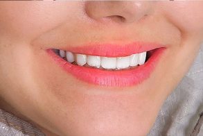 بلیچینگ-دندان-یا-سفید-کردن-دندان-در-اصفهان