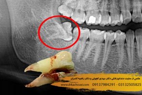 جراحی دندان عقل در اصفهان | دندانپزشکی دکتر مهدی کچوئی و دکتر راضیه کامران