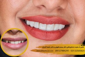 ونیر کامپوزیت دندان اصفهان | دندانپزشکی دکتر کچوئی و دکتر کامران